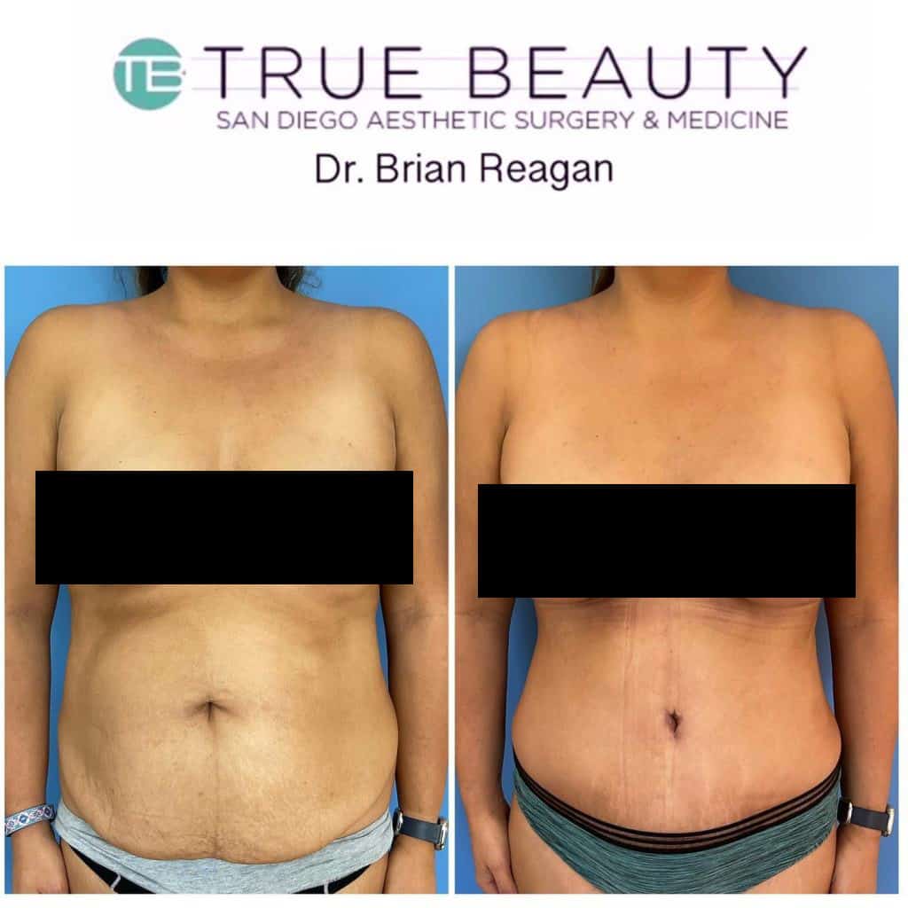 Schedule a Tummy Tuck Consultation