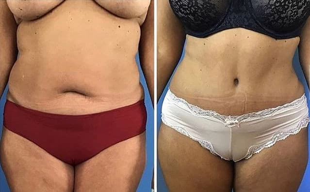 Tummy tuck before and after in San Diego & La Jolla