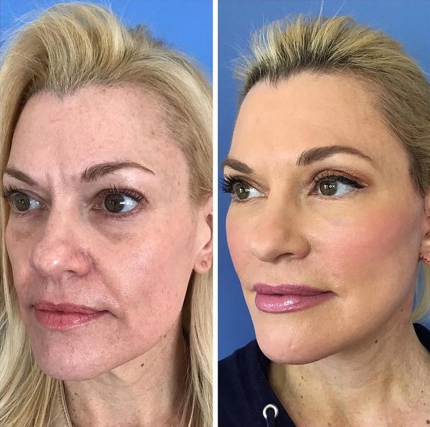 Facelift before and after in San Diego & La Jolla