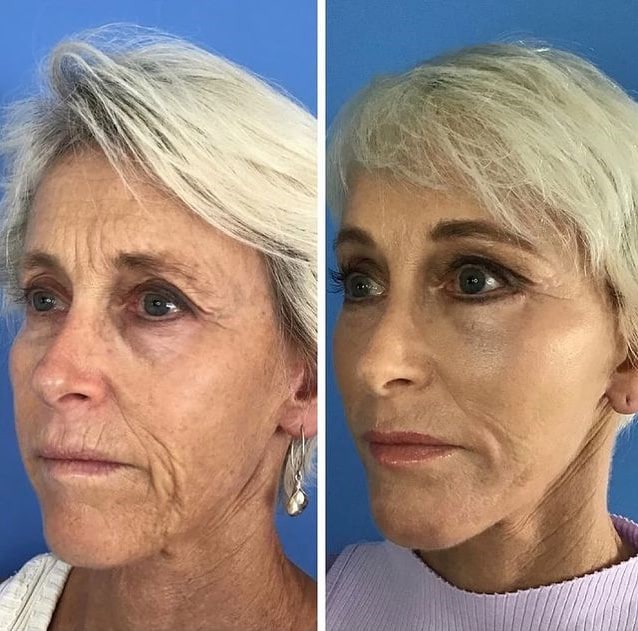 Facelift before and after in San Diego