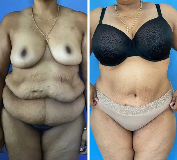 Tummy tuck before and after in San Diego