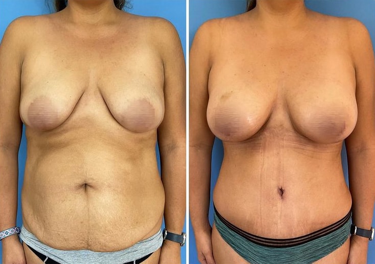 Mommy Makeover Before and After in San Diego & La Jolla