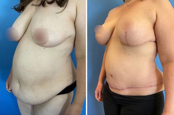 Mommy Makeover Before and After in San Diego