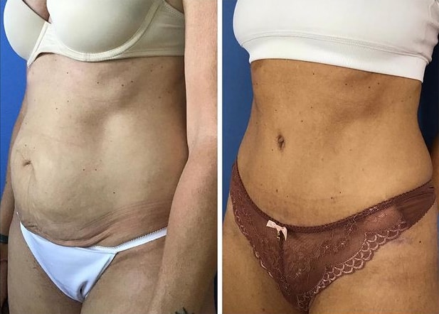Tummy tuck before and after in La Jolla