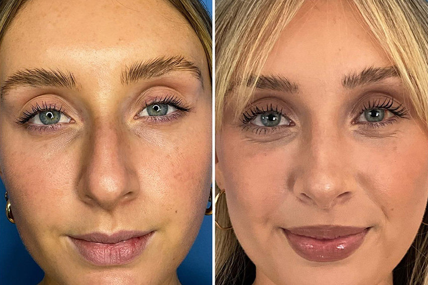 Rhinoplasty_2 Before & After in San Diego & La Jolla