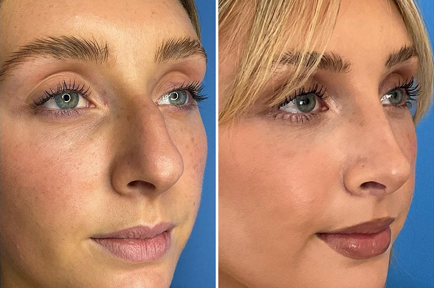 Rhinoplasty_3 Before & After in San Diego & La Jolla