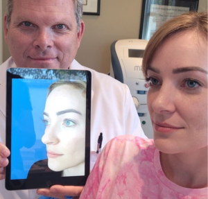 Rhinoplasty FAQs in san diego