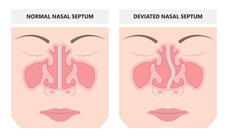 Functional Rhinoplasty in La Jolla 