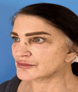 Woman with clear skin after peel in San Diego, CA