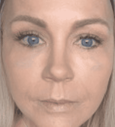 Woman with refreshed appearance after eye rejuvenation in San Diego, CA
