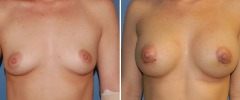 breast-aug-33