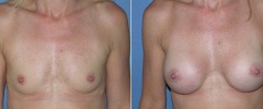 breast_b_a_3