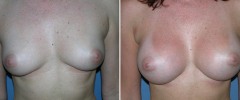 breast_b_a_4