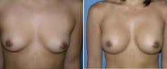 breast_ba_1